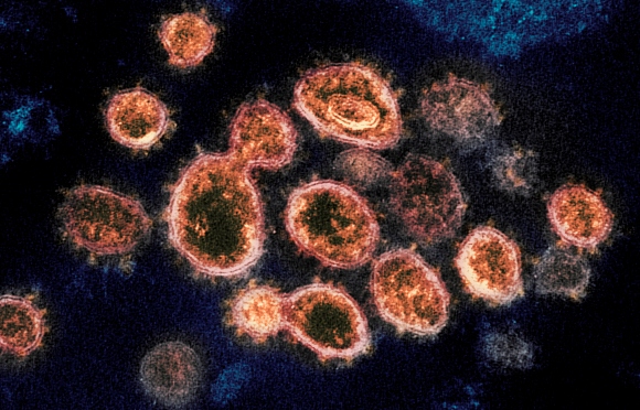 This image shows SARS-CoV-2 virus particles