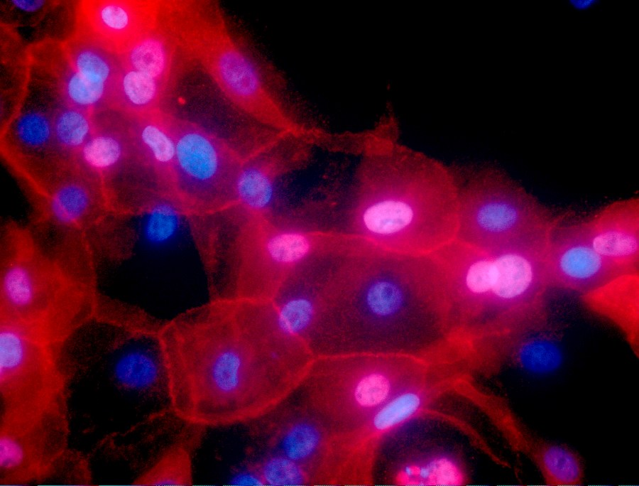 This undated fluorescence-colored microscope image made available by the National Institutes of Health in September 2016 shows a culture of human breast cancer cells.