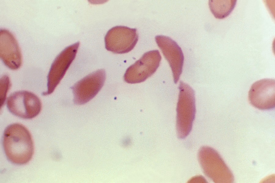 FILE - This microscope photo provided on Oct. 25, 2023, by the Centers for Disease Control and Prevention shows crescent-shaped red blood cells from a sickle cell disease patient in 1972. Britain's medicines regulator has authorized the world's first gene therapy treatment for sickle cell disease, in a move that could offer relief to thousands of people with the crippling disease in the U.K. In a statement on Thursday, Nov. 16, 2023, the Medicines and Healthcare Regulatory Agency said it approved Casgevy, the first medicine licensed using the gene editing tool CRISPR, which won its makers a Nobel prize in 2020. (Dr. F. Gilbert/CDC via AP, File )