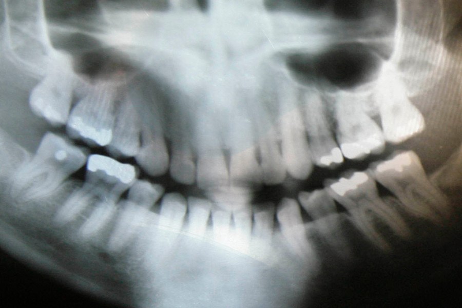 FILE - A dental X-ray is displayed in St. Johnsbury, Vt., on Thursday, Feb. 1, 2007. The American Dental Association Council on Scientific Affairs said Thursday, Feb. 1, 2024, it will no longer recommend the use of lead aprons and thyroid collars on patients who are getting dental X-rays. (AP Photo/Toby Talbot, File)