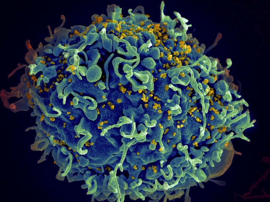 FILE - This electron microscope image made available by the U.S. National Institutes of Health shows a human T cell, in blue, under attack by HIV, in yellow, the virus that causes AIDS. (Seth Pincus, Elizabeth Fischer, Austin Athman/National Institute of Allergy and Infectious Diseases/NIH via AP, File)