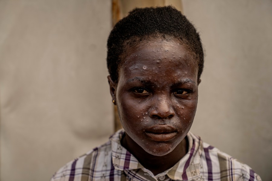 A young girl suffering from mpox waits for treatment at a clinic in Munigi, eastern Congo, Monday, Aug. 19, 2024. Congo will receive the first vaccine doses to address its mpox outbreak next week from the United States, the country's health minister said Monday, days after the World Health Organization declared mpox outbreaks in Africa a global emergency. (AP Photo/Moses Sawasawa)