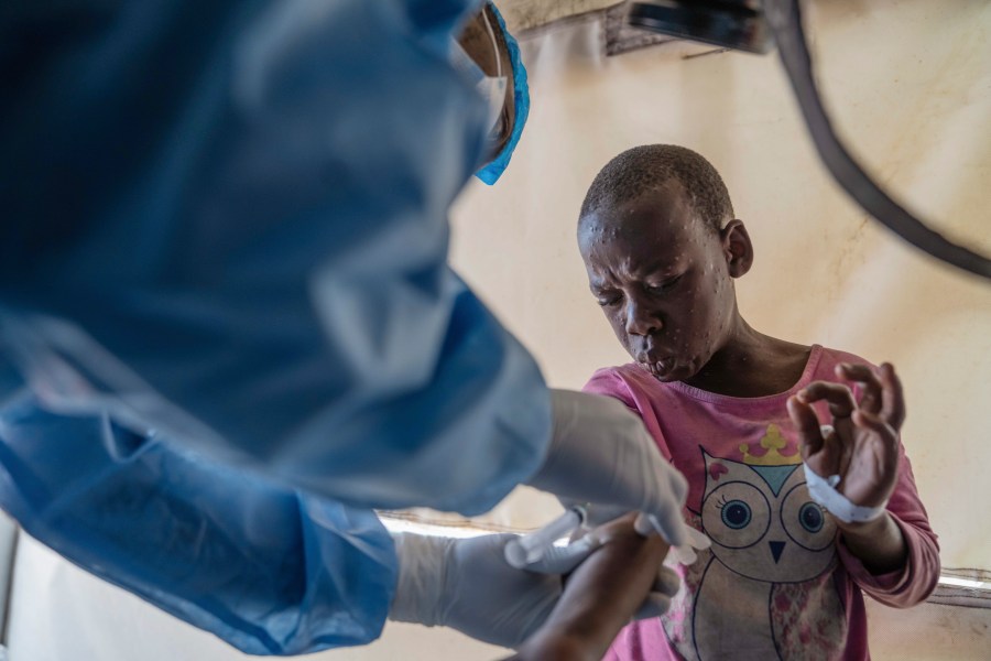 A health worker attends to a mpox patient, at a treatment centre in Munigi, eastern Congo, Monday, Aug. 19, 2024. Congo will receive the first vaccine doses to address its mpox outbreak next week from the United States, the country's health minister said Monday, days after the World Health Organization declared mpox outbreaks in Africa a global emergency. (AP Photo/Moses Sawasawa)